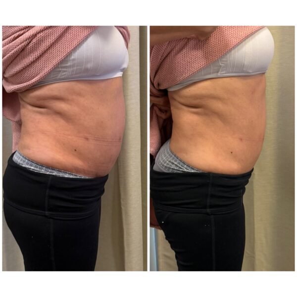 HIFU - High-Frequency Focused Ultrasound Body Sculpting - Image 2