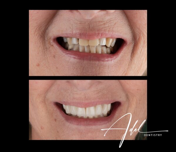 Veneers - Image 2